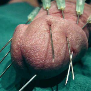Photo: CBT - Torture Play Piercing Anatomia Glande